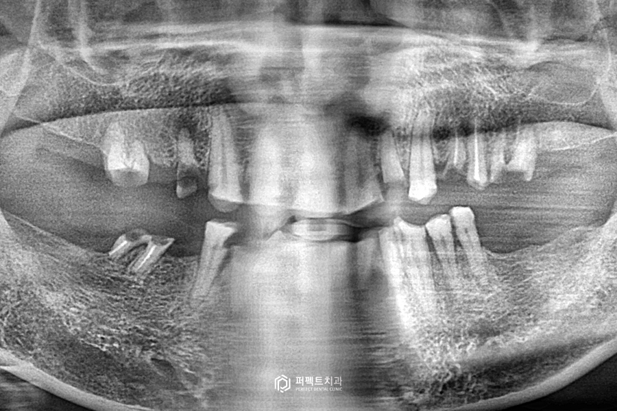 살릴 수 있는 치아가 없다면?❌｜전체임플란트 수복 관련 이미지 2