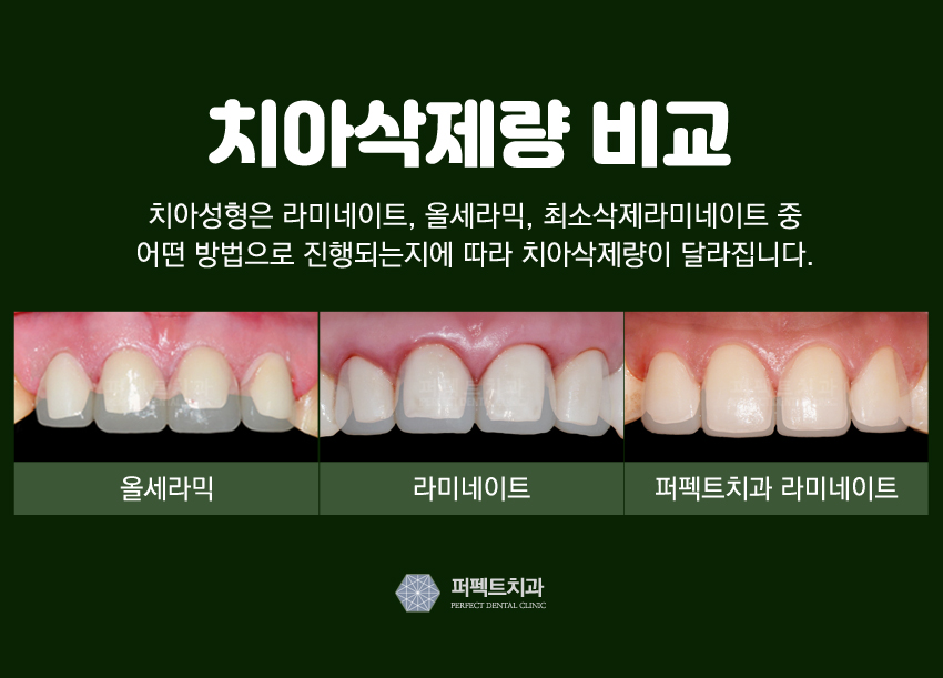 앞니성형 믿고 할 수 있는 치과! 관련 이미지 3