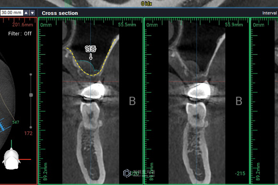 임플란트를 해야하는데 상악동에 염증이..😭 관련 이미지 5