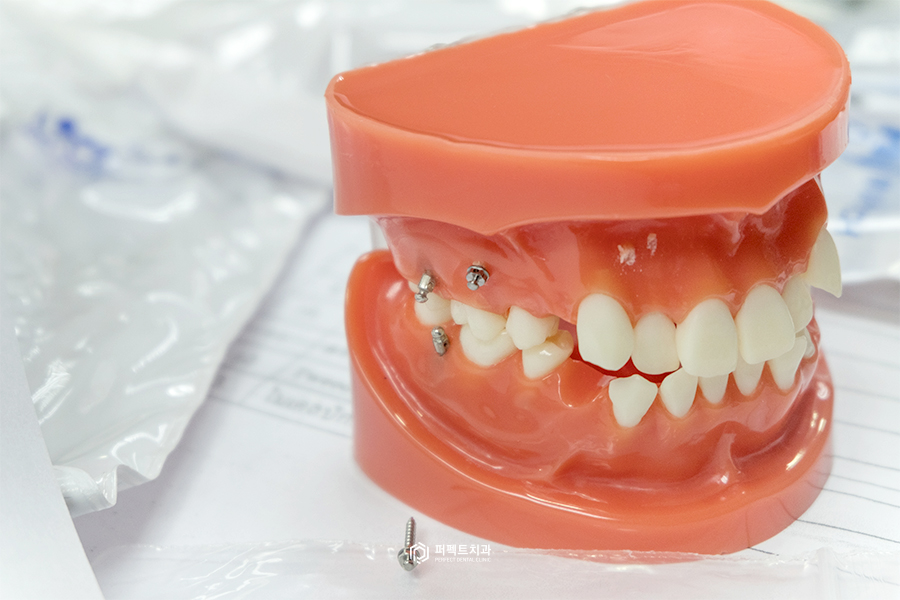 미니스크류｜치아교정 시 잇몸에 심는 나사는? 관련 이미지 1