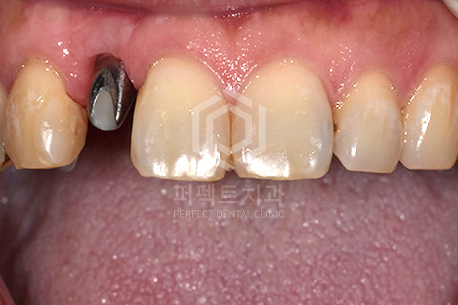 앞니 임플란트 후 잇몸이 까매진다? 관련 이미지 2