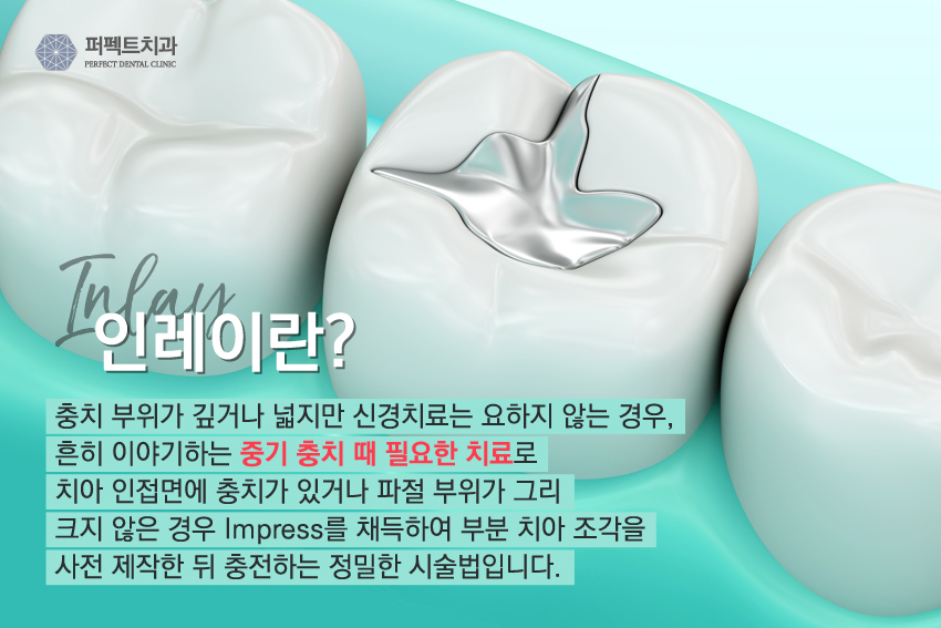 세라믹 인레이 충치치료 비용 관련 이미지 2
