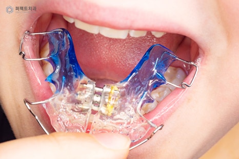 악궁확장장치 MARPE, 사용하는 이유는? 관련 이미지 5