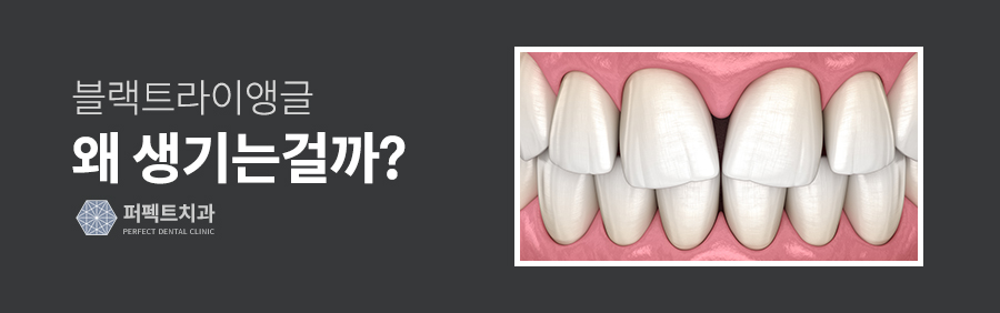 블랙트라이앵글, 치아교정의 부작용일까? 관련 이미지 3