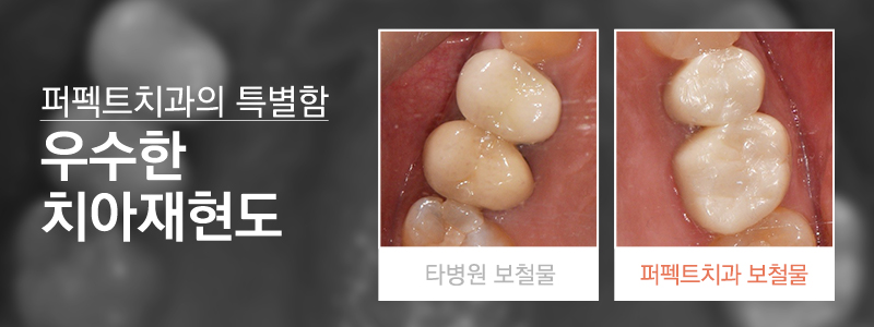 지르코니아 크라운 가격 궁금해? 관련 이미지 5