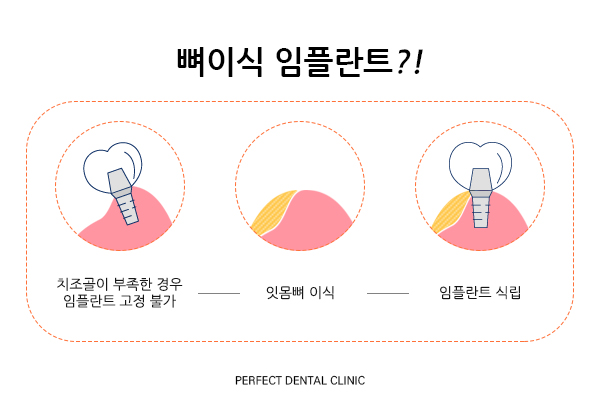 강남 오스템임플란트 저렴한 비용! 관련 이미지 3