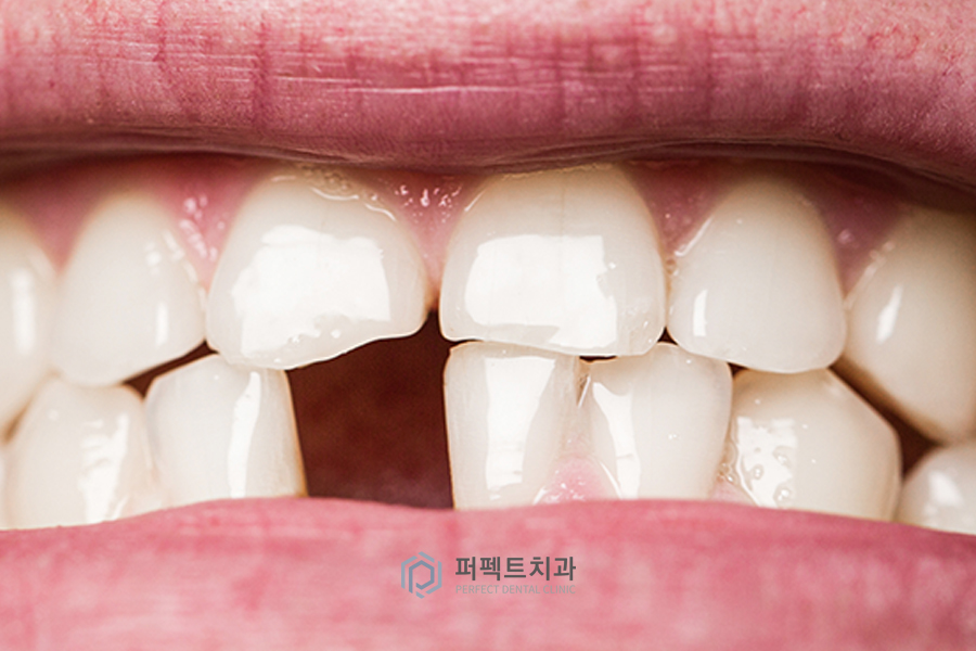 치아가 없을 때 할 수 있는 치료? - ①임플란트편 관련 이미지 1