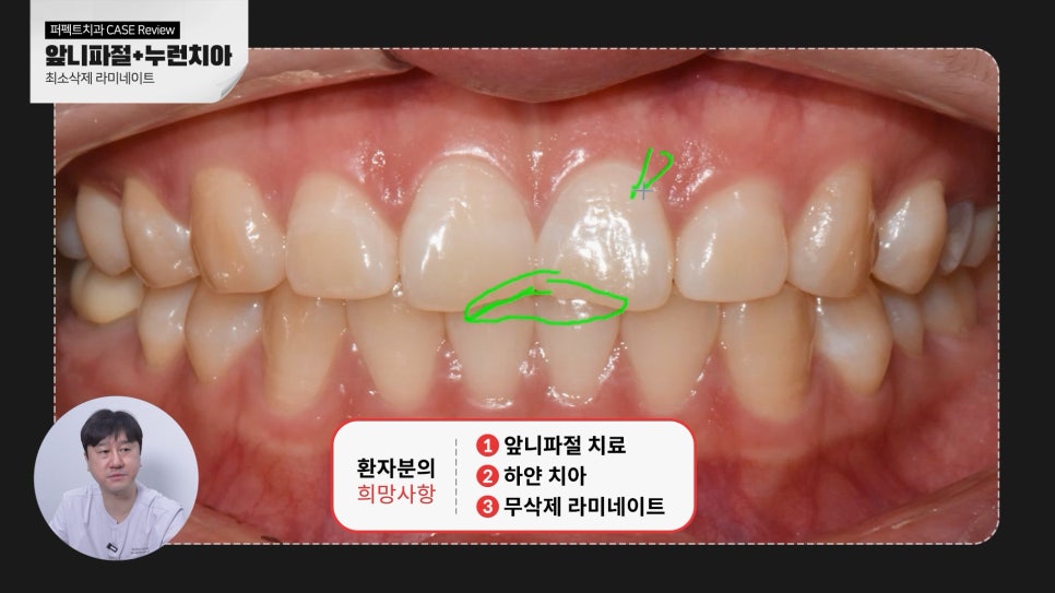 깨진앞니+나비치아 무삭제라미네이트 관련 이미지 3