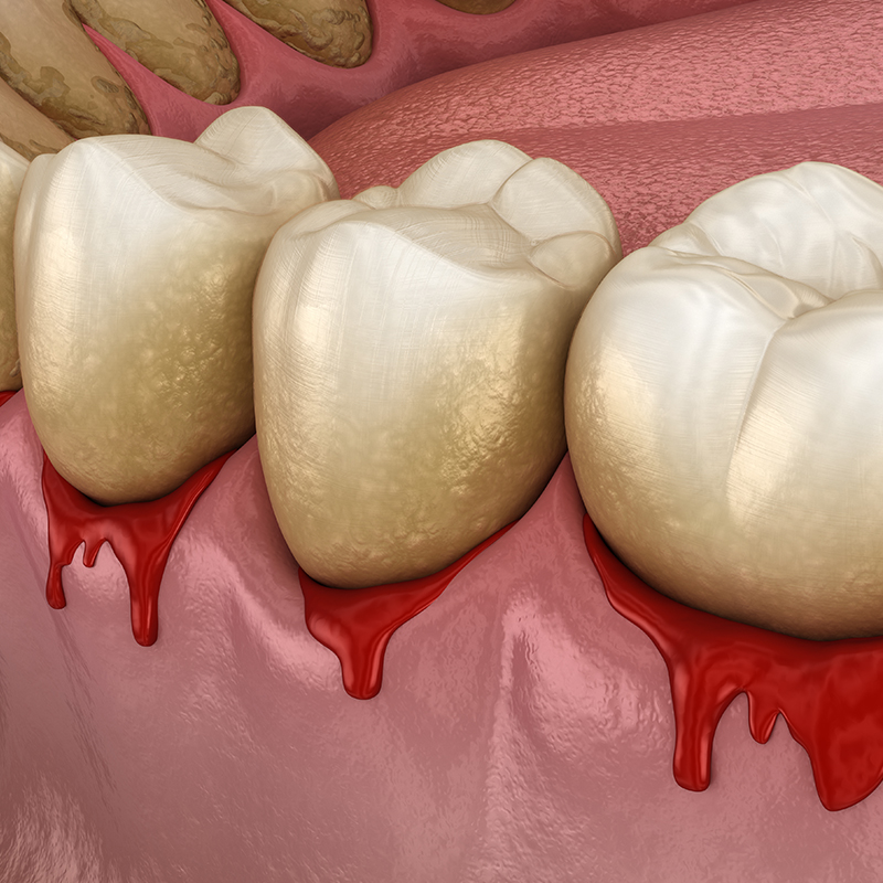 임플란트 한 치아에도 충치가 생길 수 있을까? 관련 이미지 4