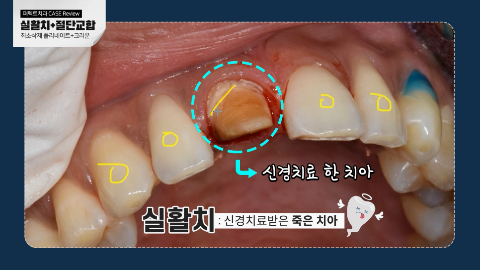 남자라미네이트, 더 오래 사용하려면? 관련 이미지 6