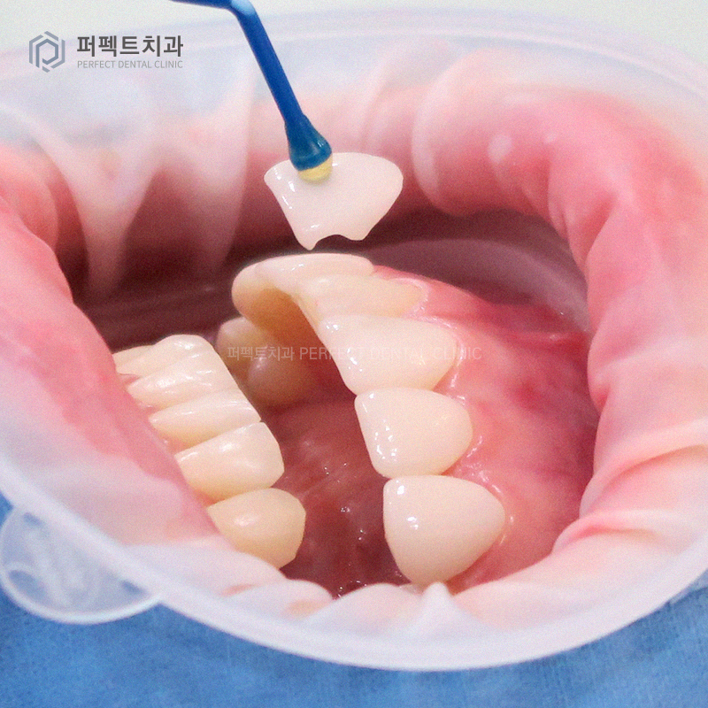 탈락한 라미네이트 재부착 가능할까요? 관련 이미지 2