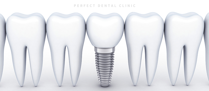 임플란트 흡연, 주의사항 정리임플란트 흡연, 주의사항 정리 관련 이미지 2