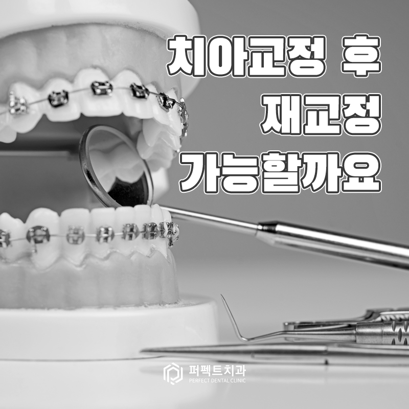 치아교정 후 재교정이 가능할까요? 관련 이미지 1