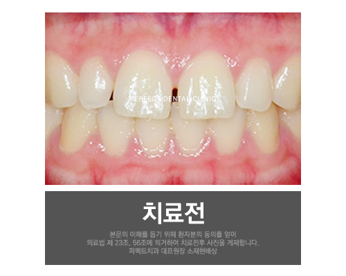 치아교정 후 치아모양이 마음에 들지않으면? 관련 이미지 2