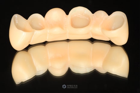 임플란트 후 임시치아, 임시틀니① 관련 이미지 2