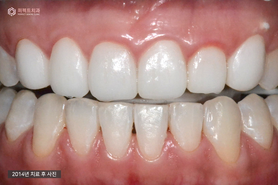 충치치료+교정 후 라미네이트, 세가지 복합적인 치료의 기간은?! 관련 이미지 5