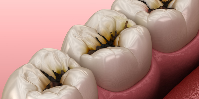 충치치료비용 알고 가자! 관련 이미지 3