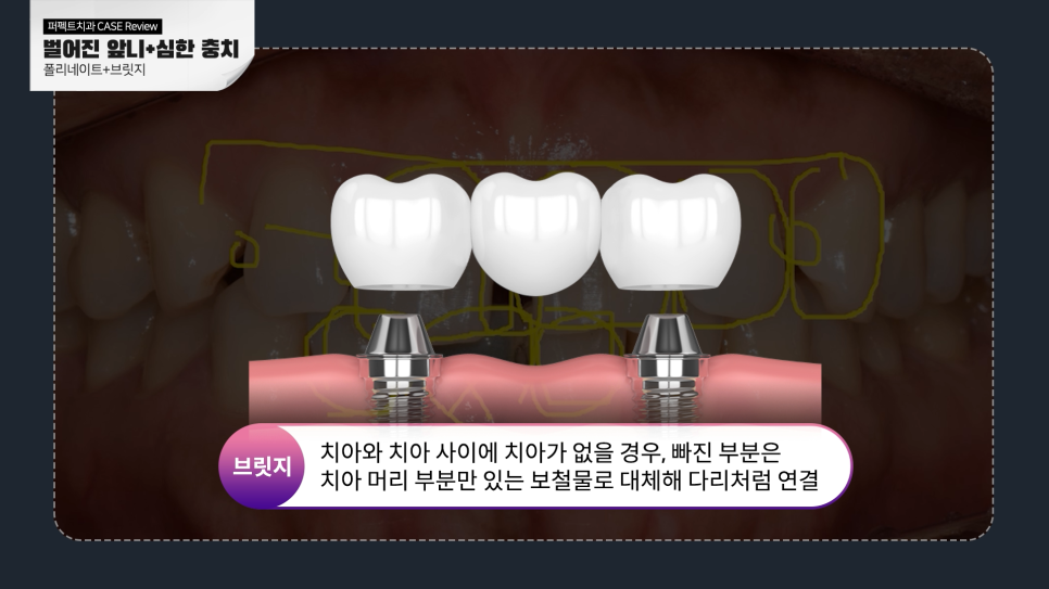 앞니충치, 벌어짐 동시에 치료하는 방법 관련 이미지 5