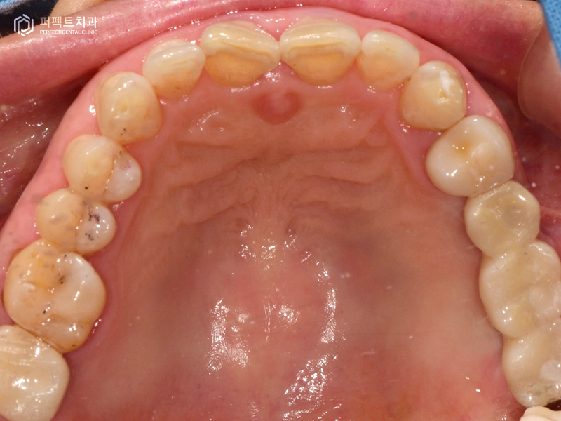 장거리+다수의 임플란트 케이스 관련 이미지 9