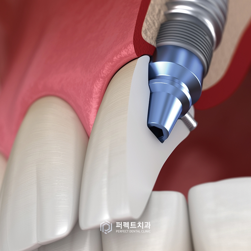 임플란트를 할 경우 발치한 공간은 비어있어야 하나요? 관련 이미지 2