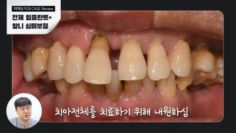 전악 임플란트 비용 궁금하다면 관련 이미지 3