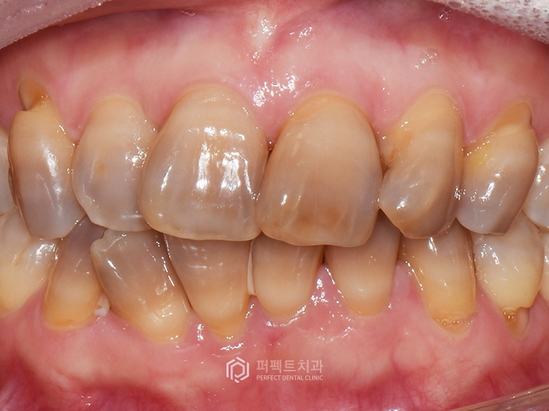테트라사이클린 치아변색 폴리네이트 케이스 관련 이미지 7