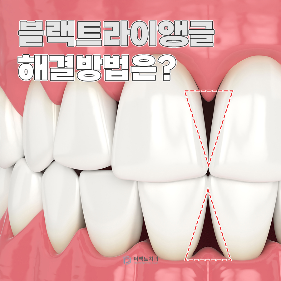 '블랙트라이앵글' 해결 방법은? 관련 이미지 1