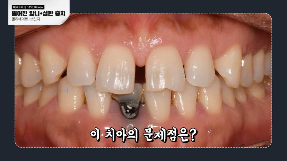 앞니충치, 벌어짐 동시에 치료하는 방법 관련 이미지 2