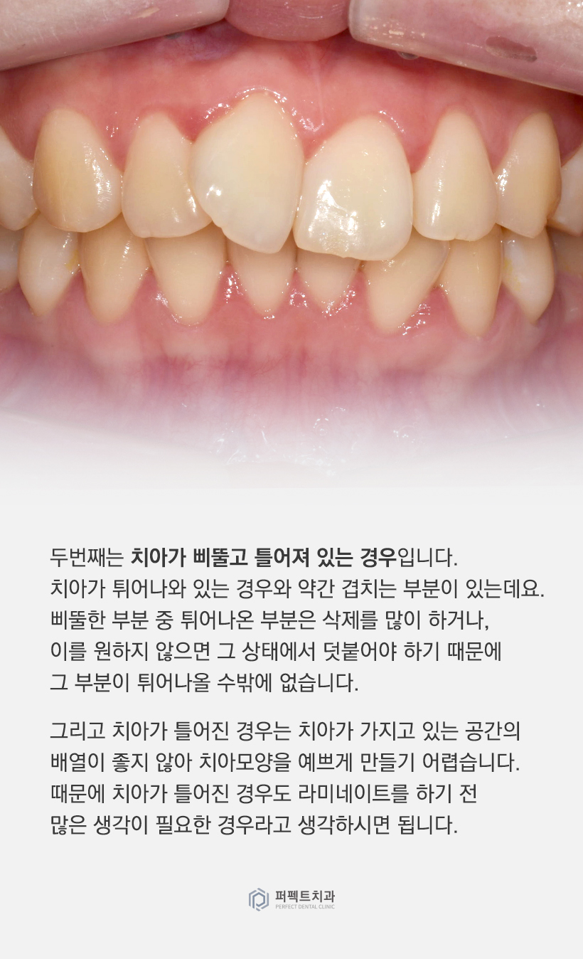 어떤 경우에 라미네이트를 하면 안되나요? 관련 이미지 2