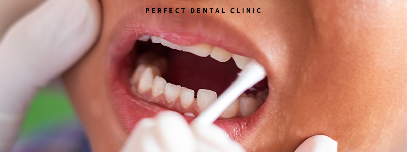 불소도포, 불소치약 활용법 관련 이미지 3