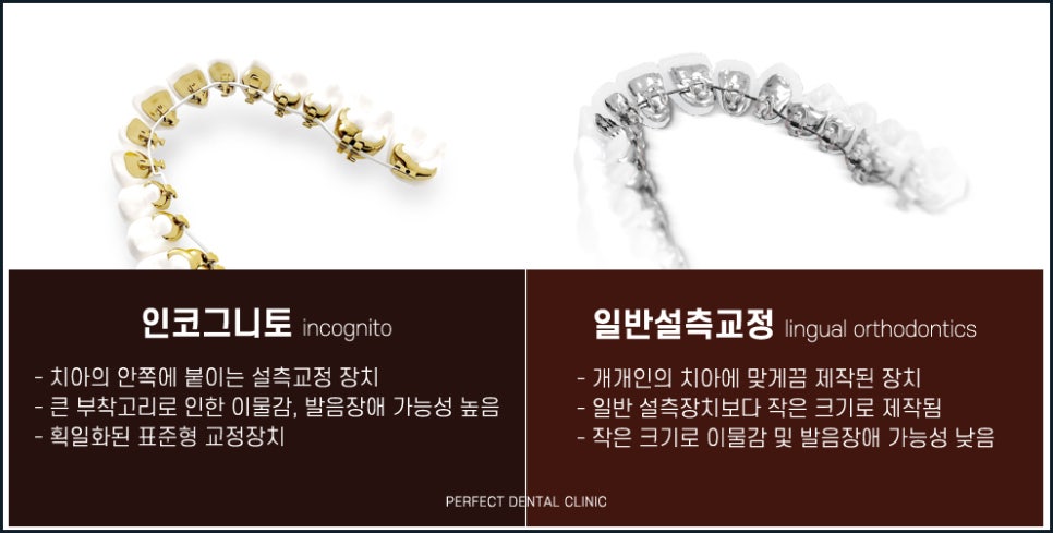 치아안쪽에 부착하는 설측교정! 관련 이미지 4