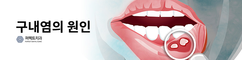 유아 구내염 원인, 치료법 관련 이미지 2