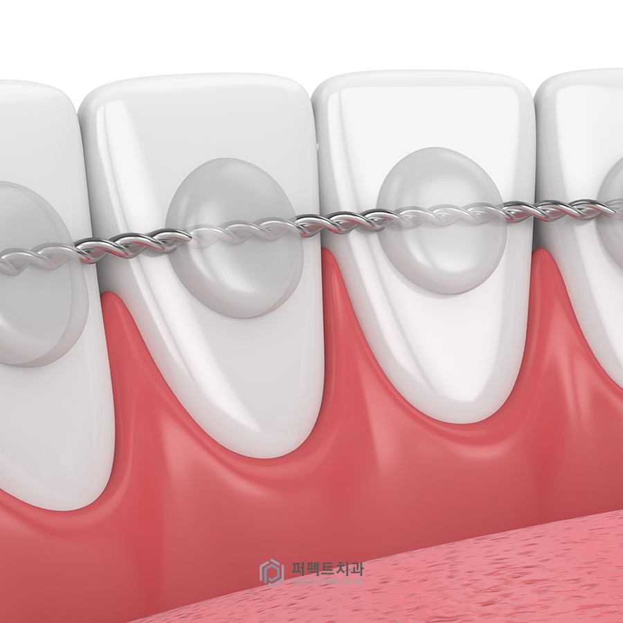 라미네이트 후 교정 유지장치는? 관련 이미지 3