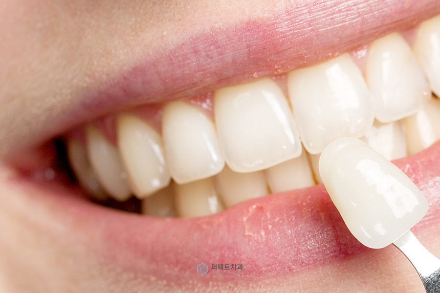 라미네이트가 떨어졌는데 꼭 재시술 해야할까요? 관련 이미지 1