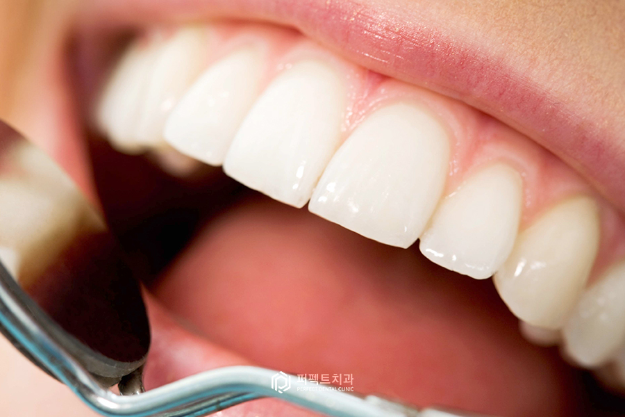 직접 받아본✨치아미백 과정① 관련 이미지 9