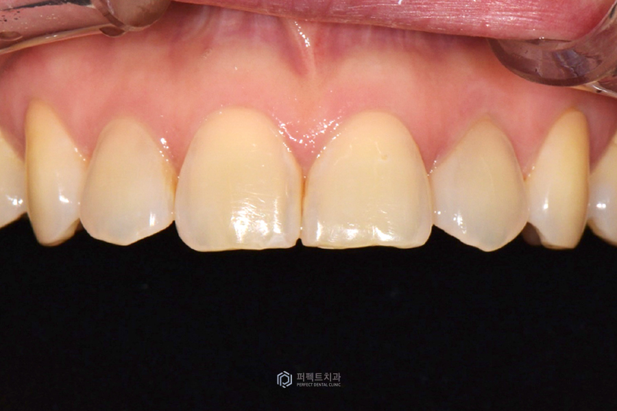 개방교합(open bite)을 라미네이트로 해결할 수 있을까? 관련 이미지 2