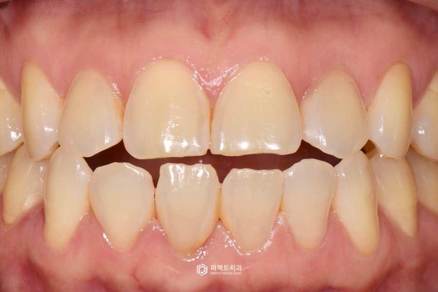 개방교합(open bite)을 라미네이트로 해결할 수 있을까? 관련 이미지 4