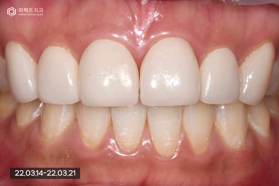 앞니 돌출 있는데 폴리네이트로 극복 가능..?🤔 관련 이미지 7