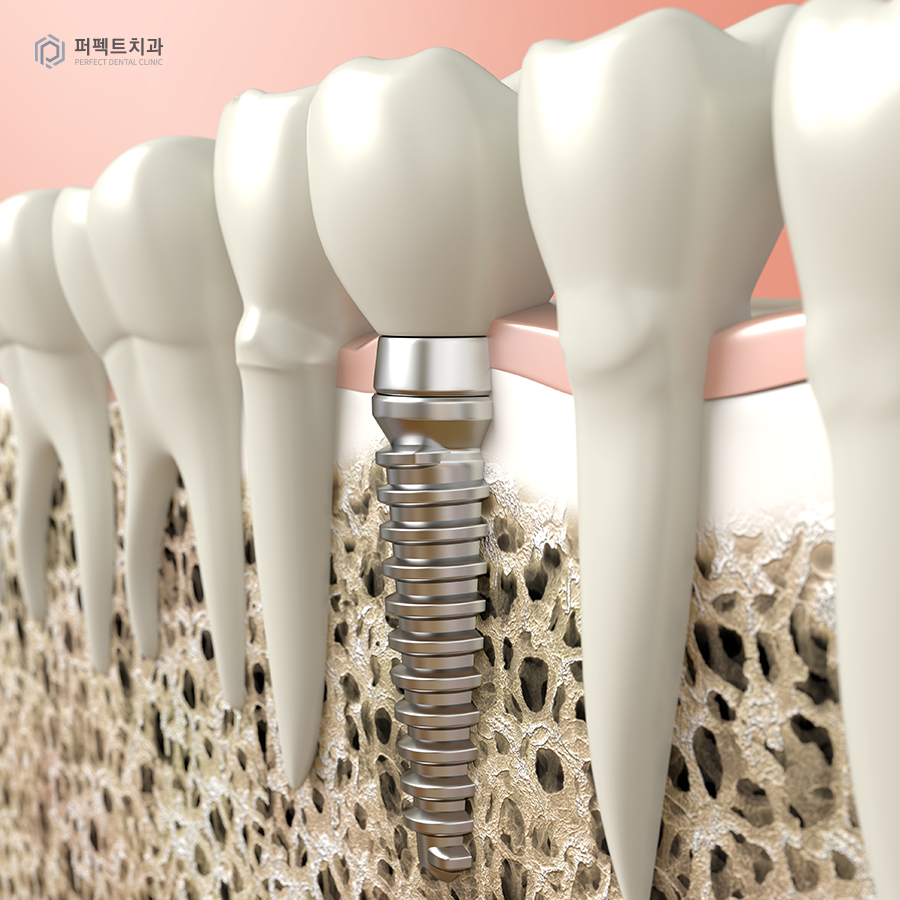임플란트 부작용, 어떤 경우에 주의해야 할까? 관련 이미지 5