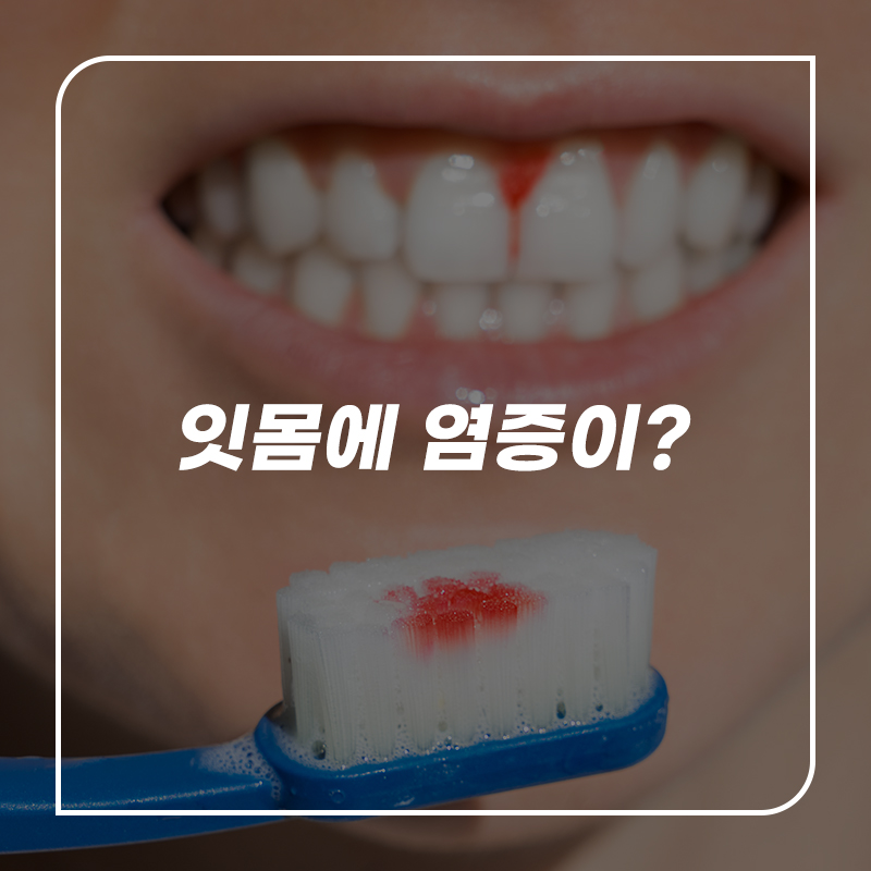 잇몸에 염증 종류와 치과치료 관련 이미지 1
