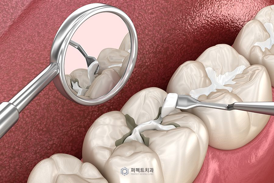 초기 충치치료, 어떤 재료가 있을까? 관련 이미지 1