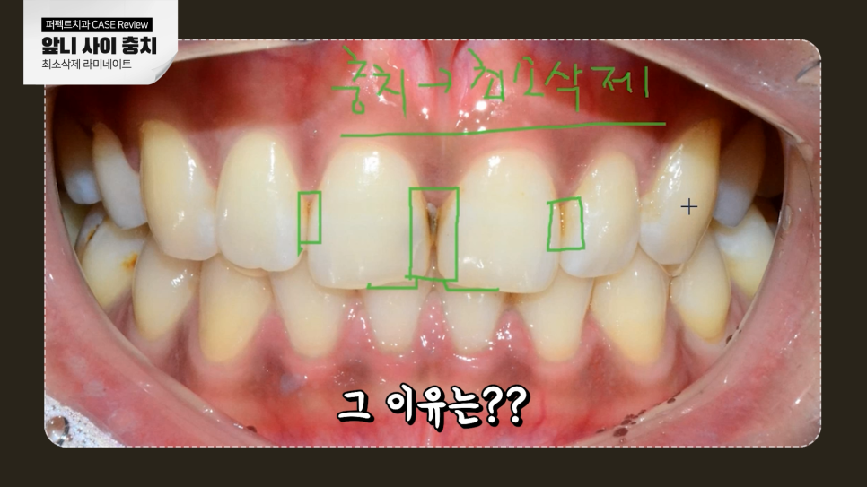 앞니 사이 충치, 어떻게 치료해야 티 안 날까? 관련 이미지 5