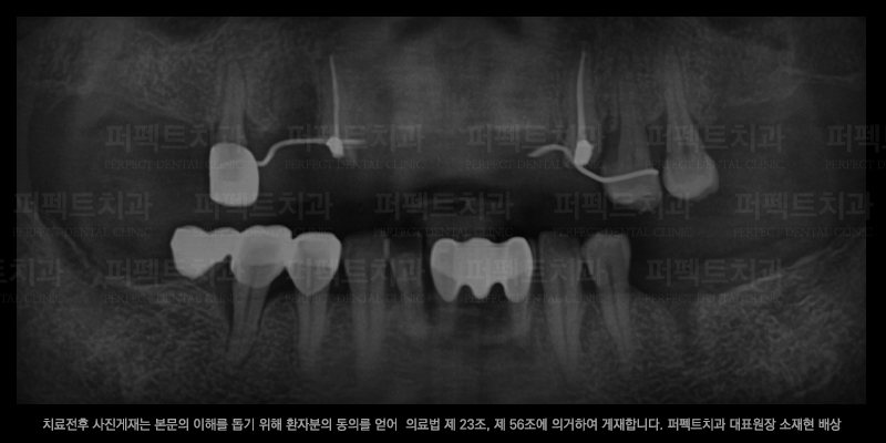 선릉역치과, 임플란트 선택 기준은? 관련 이미지 2