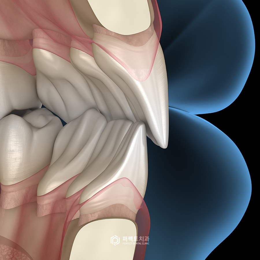 라미네이트가 자꾸 깨지는 이유는? 관련 이미지 2