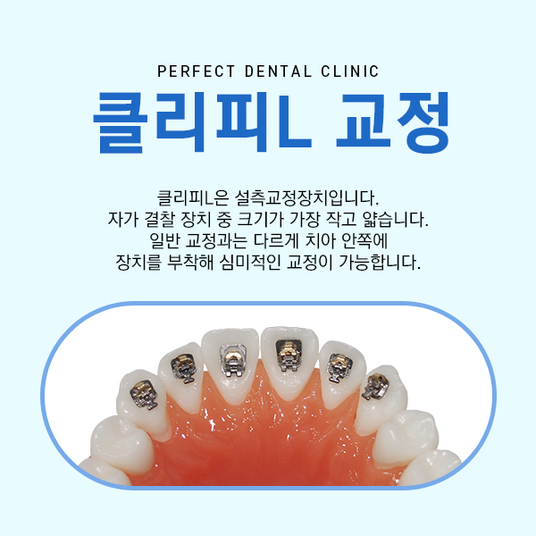 앞니 부분교정 비용 관련 이미지 4