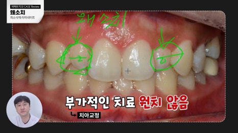 주변 치아보다 작은 관련 이미지 4