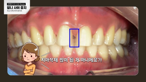 앞니 사이 충치치료와 폴리네이트 관련 이미지 6