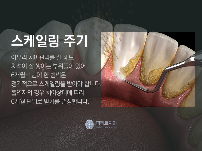 스케일링 아픈가요? 관련 이미지 3
