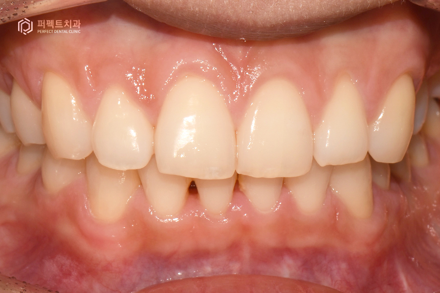 삐뚤거리는 아랫니를 6개월만에 반듯하게?! 관련 이미지 2