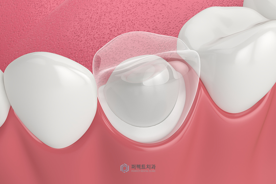 충치치료 했는데 아파요..(크라운&치아크랙) 관련 이미지 1